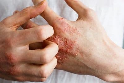 Occupational Skin Conditions